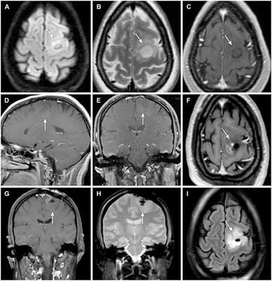 High-Dose Fluorescein Reveals Unusual Confocal Endomicroscope Imaging of Low-Grade Glioma